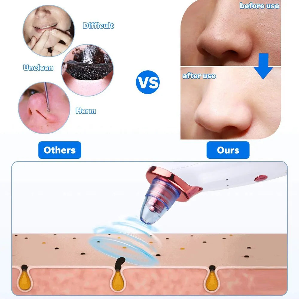 Portable Blackhead Remover – Home Use Suction Tool